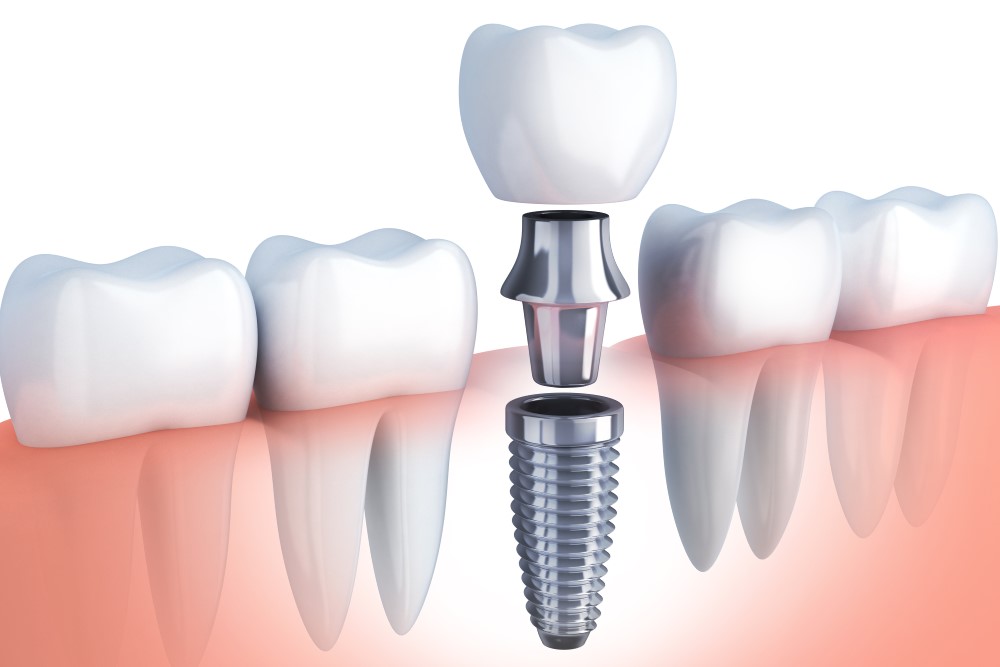 Dental Implants Market to Reach a Value of US$ 5,725.7, CAD/CAM Technology to Facilitate Cost Effectiveness and Flapless Surgeries, Says Fortune Business Insights